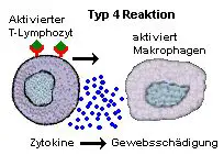 Hauptakteur beim Typ 4 sind die T-Zellen der spezifischen Abwehr.