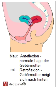 Rckwrtsneigung der Gebrmutter