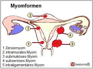 Myomformen