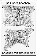 Osteoporose zehrt die Knochenstruktur auf.