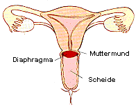 Bei richtigem Sitz verschließt das Diaphragma den Muttermund.