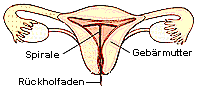 Die Spirale und ihr richtiger Sitz in der Gebärmutter.