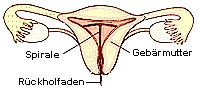 Die Spirale und ihr richtiger Sitz in der Gebrmutter.