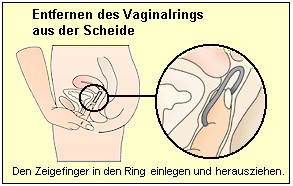 Entfernen des Vaginalrings aus der Scheide