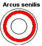 Arcus senilis