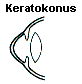 Keratokonus