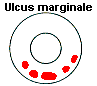 Ulcus marginale