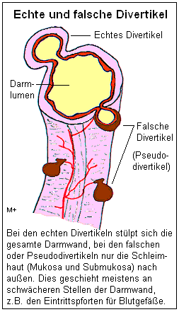 Pseudodivertikel sind hufiger, als echte Divertikel