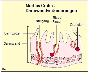 Darmwandveränderungen bei Morbus Crohn