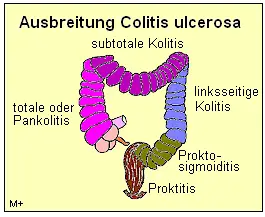 Ausbreitung der Colitis ulcerosa