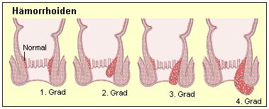 Hmorrhoiden werden in Stadien eingeteilt.