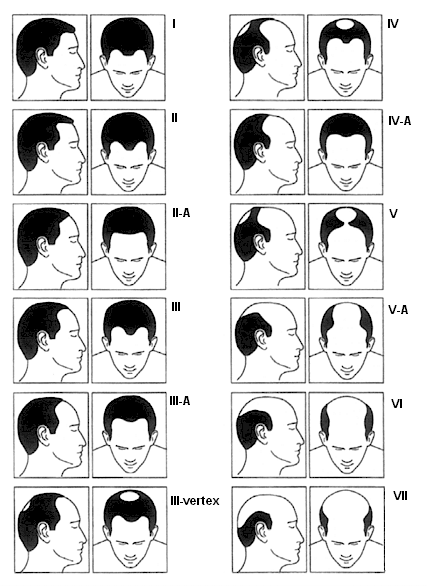 Das Hamilton-Norwood-Schema zeigt den typischen Verlauf der androgenetischen Alopezie
