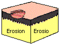 Erosionen betreffen nur die Oberhaut.