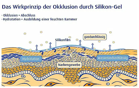 Der Silikonschutzfilm deckt die Narbe ab und hlt sie feucht.