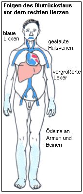 Folgen einer Blutstauung vor dem rechten Herzen.