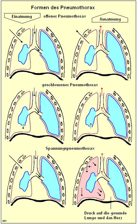 Bei Pneumothorax dringt Luft in den Pleuraspalt ein und lässt die Lunge kollabieren