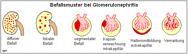 Befallsmuster bei Glomerulonephritiden