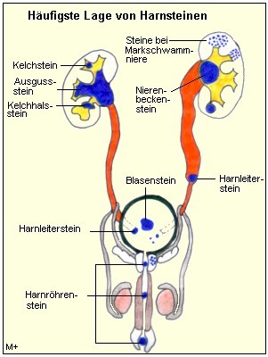 Hufige Lage von Harnsteinen