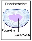 Die Bandscheibe besteht aus uerem Faserring und Gallertkern