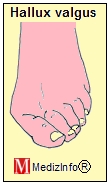 Hallux valgus