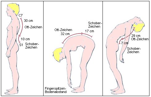 Die Beweglichkeit der Wirbelsule kann exakt gemessen werden.