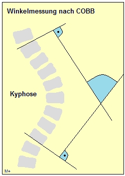 Kyphose - Winkelmessung nach COBB