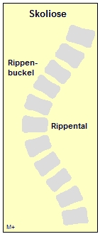 Skoliose