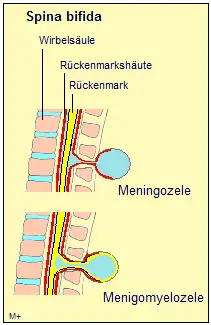 Spina bifida