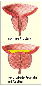 Vergrößerte Prostata mit Restharn