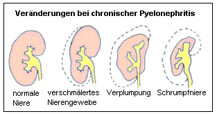 Nierenvernderungen bei chronischer Pyelonephritis