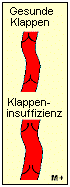 Venenklappen