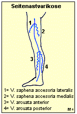 Seitenastvarikose