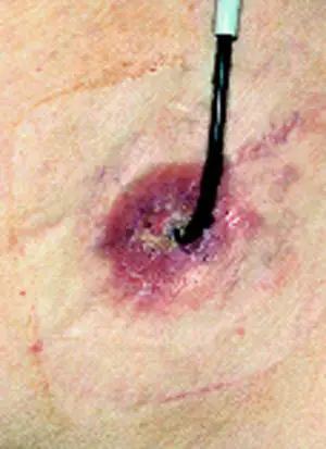 Ureter-Haut-Fistel mit Schiene, die peristomale Haut entzündlich verändert.