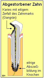 Bei einem toten Zahn ist das Zahnmark zerstört