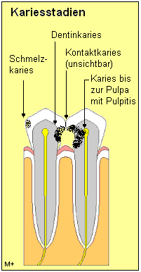 Karies entwickelt sich in drei Stadien