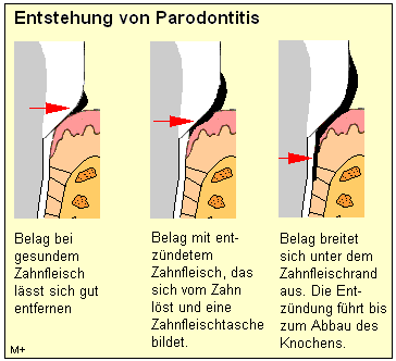 Die Entstehung von Parodontitis bleibt oft lange unbemerkt
