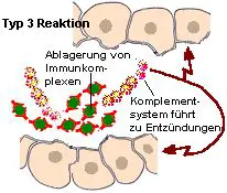Immunkomplexe können sich in Geweben ablagern und dort Allergien hervorrufen.