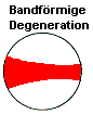 Bandförmige Degeneration