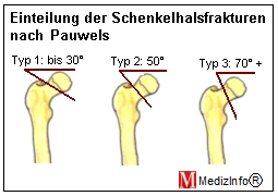 Einteilung der Schenkelhalsfrakturen nach Pauwels.