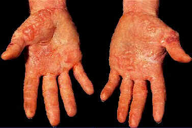 Akutes allergisches Kontaktekzem der Hände