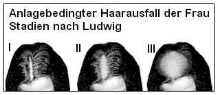 Das Ludwig-Schema zeigt den Verlauf des androgenen Haarausfalls bei Frauen
