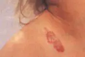 Kirschroter Blutschwamm an der Schulter eines Kleinkindes.