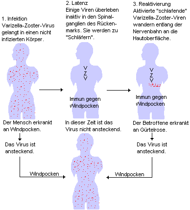 Varizella-Zoster-Viren: Zuerst die Windpocken und spter vielleicht die Grtelrose.