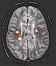 Die rot umrandeten weißen Flecken zeigen Veränderungen durch Plaques der Multiple Sklerose an.
