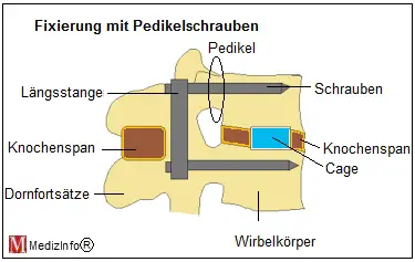 Fixierung mit Pedikelschrauben