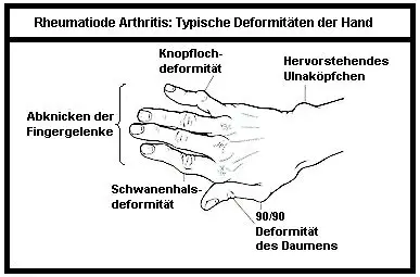 Typische Deformitäten der Hand bei RA.