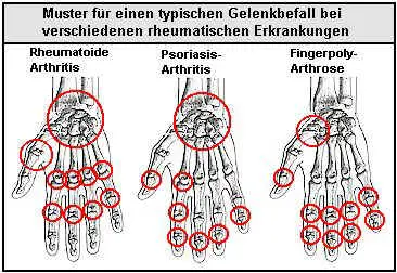 Typischer Gelenkbefall der Hände bei verschiedenen rheumatischen Krankheitsbildern.