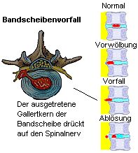 Durch Schwchung des Faserrings tritt der Gallertkern aus.