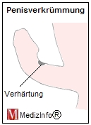 Erworbene Penisverkrmmung - IPP