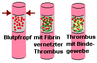 Bildungsschritte eines Thrombus